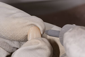 3. Alumina sandblast the surface of the crown (50-70 μm, 0.2 MPa / 2bar)